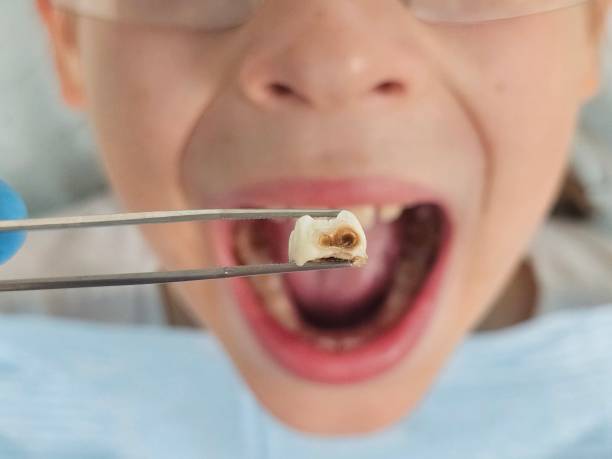 Best Pediatric Emergency Dentist in Center Point, TX